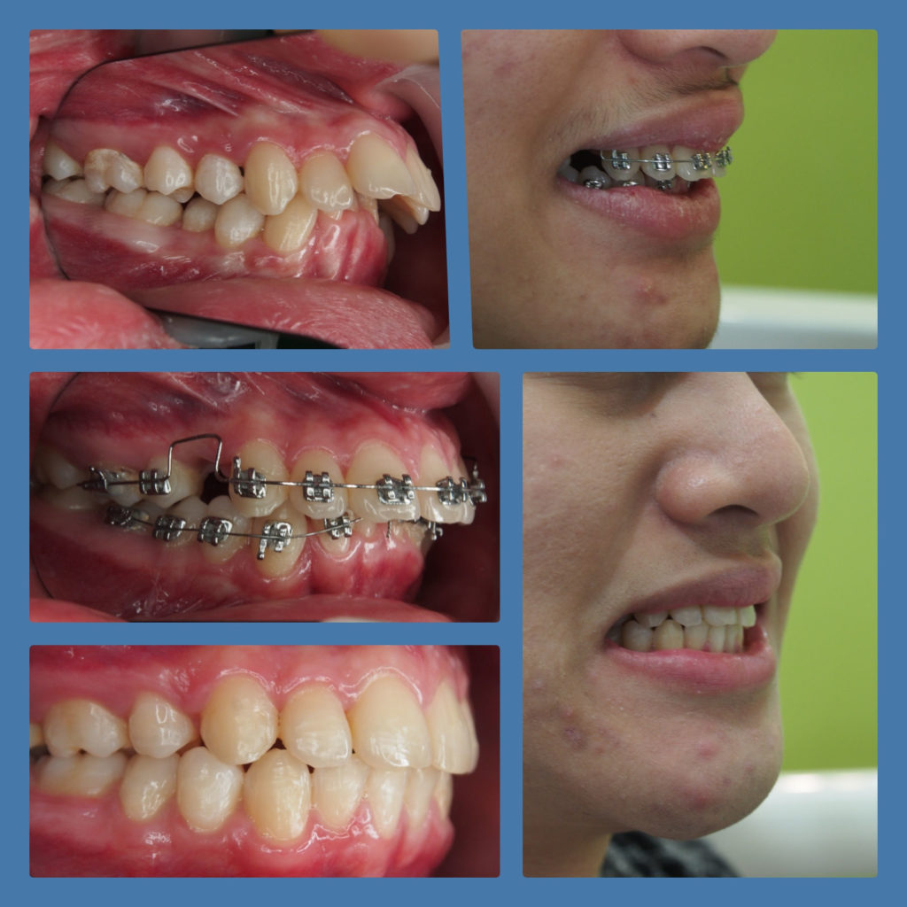 ผลงานจัดฟันของเรา | คลินิกศูนย์ทันตกรรมปากน้ำ image 11